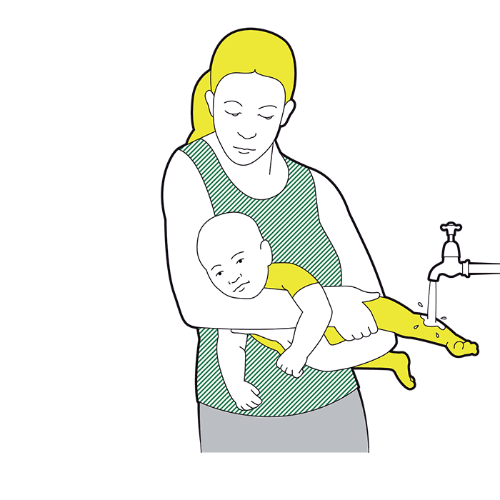 Baby minor burns and scalds - cool the burn or scald as quickly as possible