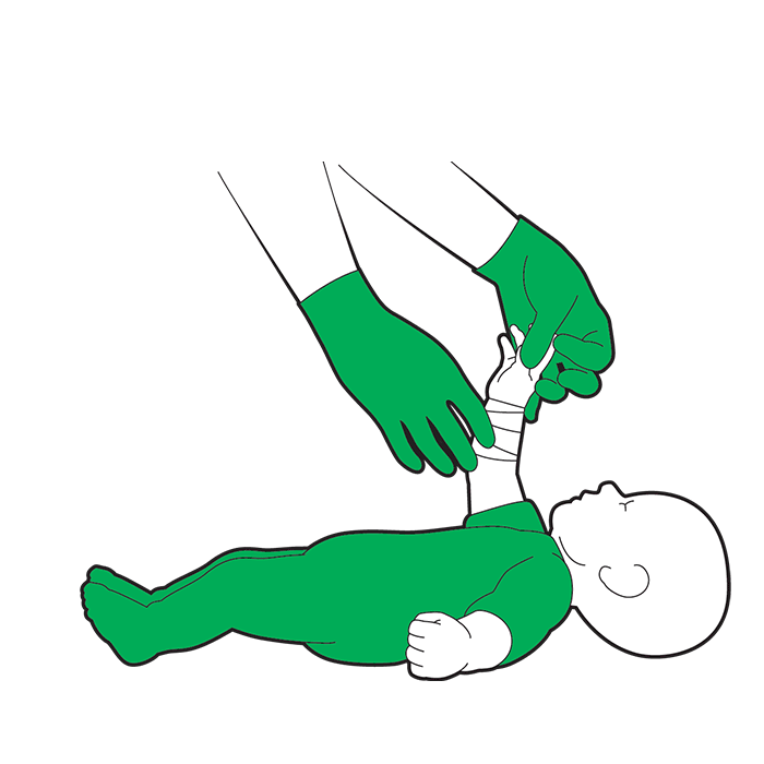 Baby severe bleed first aid - check their circulation beyond the bandage